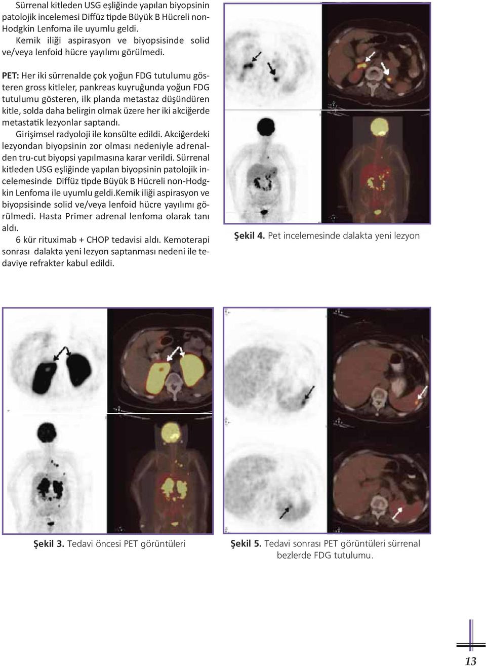 PET: Her iki sürrenalde çok yoğun FDG tutulumu gösteren gross kitleler, pankreas kuyruğunda yoğun FDG tutulumu gösteren, ilk planda metastaz düşündüren kitle, solda daha belirgin olmak üzere her iki