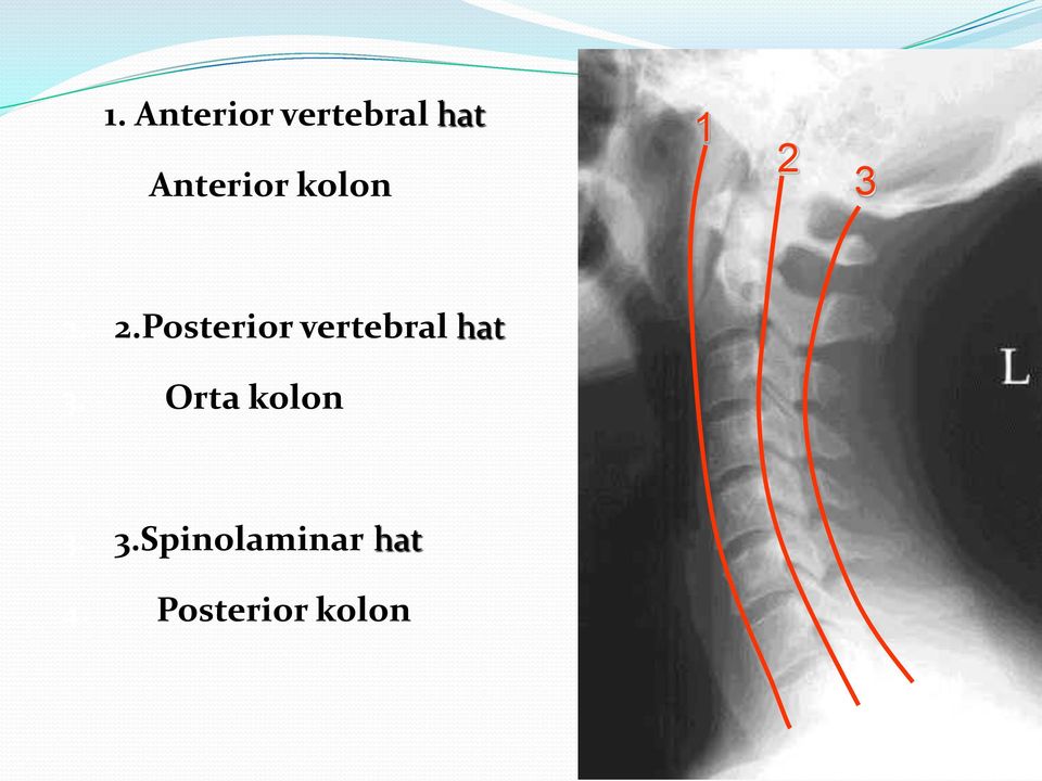 3 2. 2.Posterior vertebral hat 3.