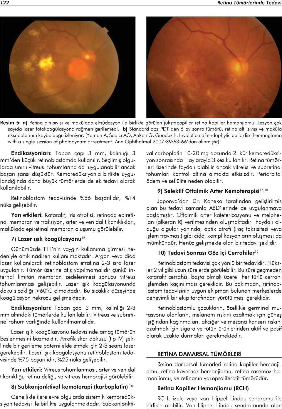 (Yaman A, Saatcı AO, Arıkan G, Gunduz K. Involution of endophytic optic disc hemangioma with a single session of photodynamic treatment. Ann Ophthalmol 2007;39:63-66 dan alınmıştır).
