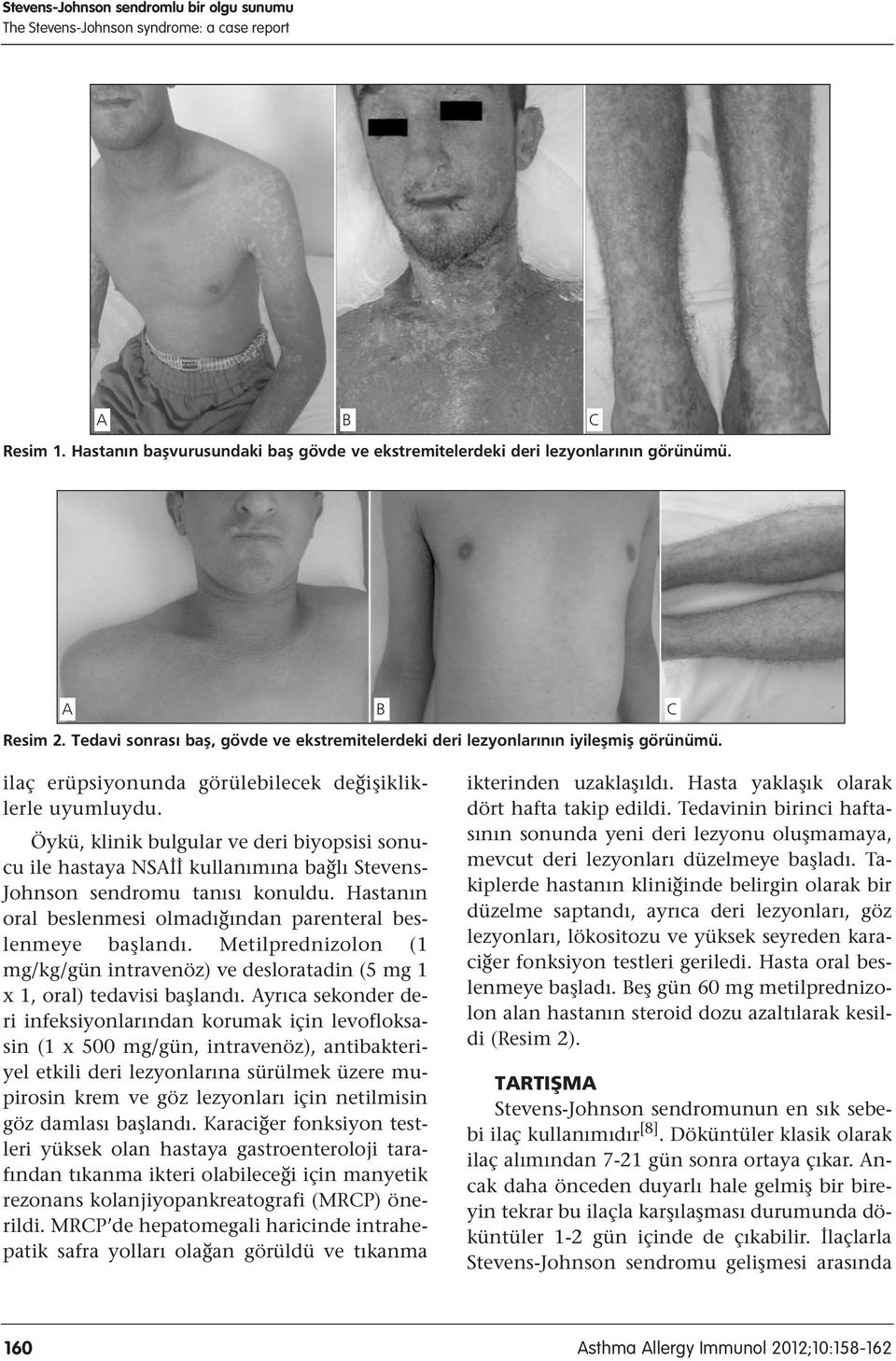 Öykü, klinik bulgular ve deri biyopsisi sonucu ile hastaya NSAİİ kullanımına bağlı Stevens- Johnson sendromu tanısı konuldu. Hastanın oral beslenmesi olmadığından parenteral beslenmeye başlandı.