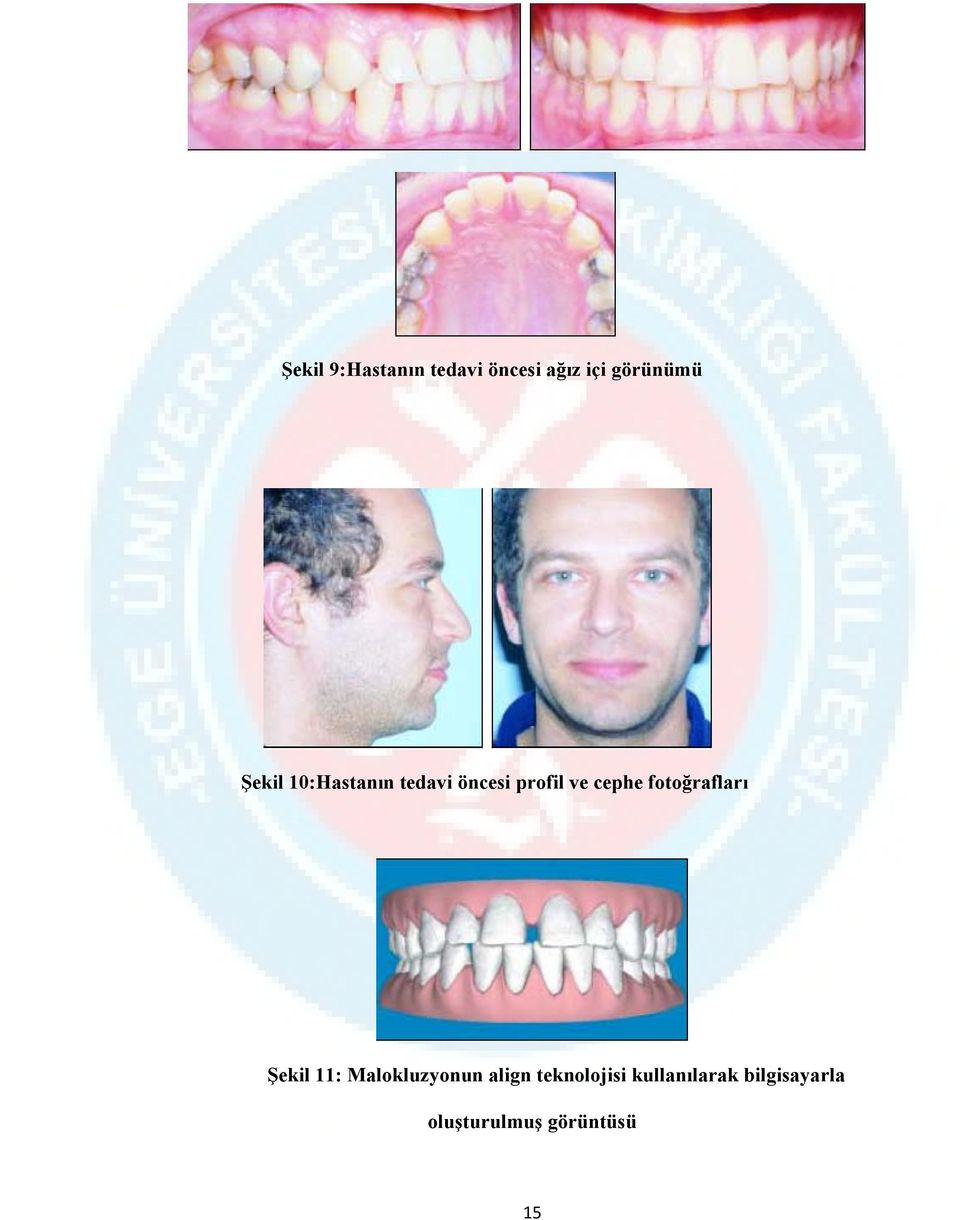 fotoğrafları Şekil 11: Malokluzyonun align