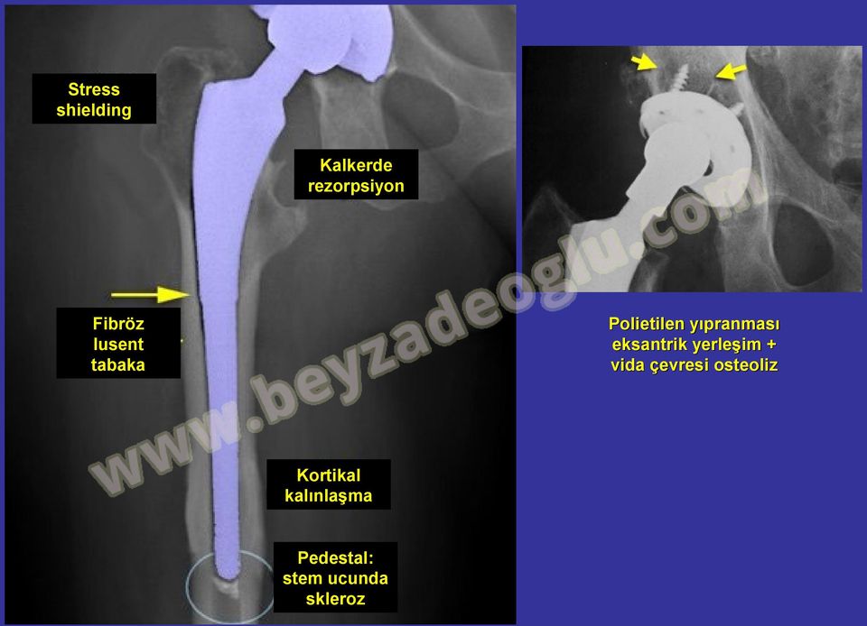 eksantrik yerleşim + vida çevresi osteoliz