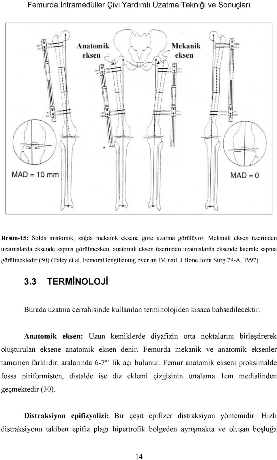 Joint Surg 79-A, 1997). 3.3 TERMİNOLOJİ Burada uzatma cerrahisinde kullanùlan terminolojiden kùsaca bahsedilecektir.