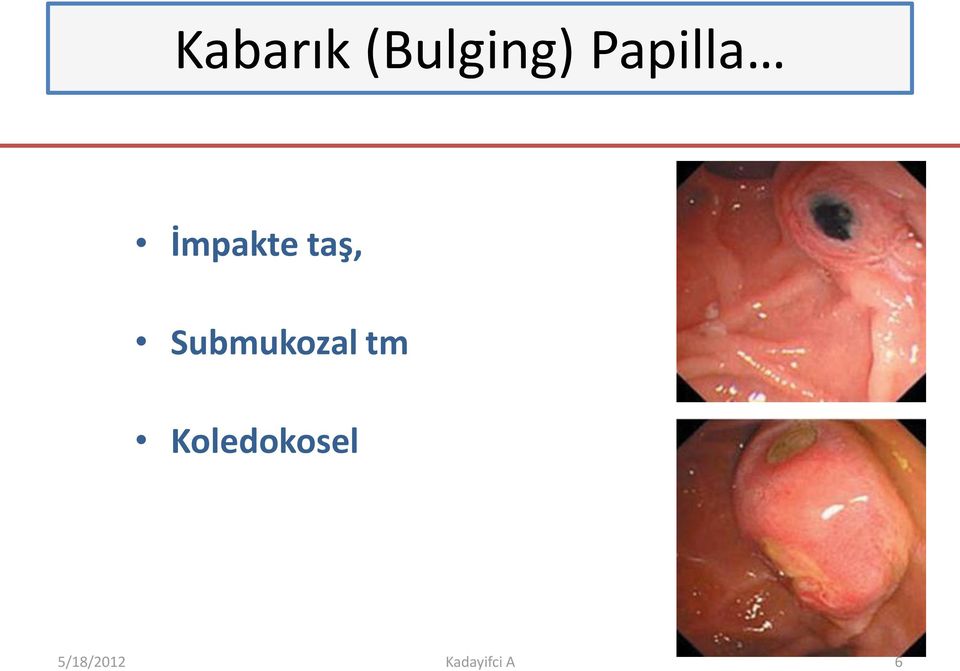 Submukozal tm