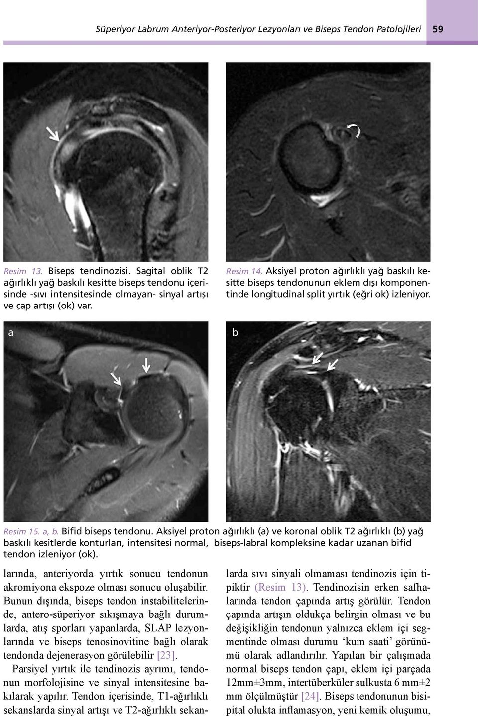 Aksiyel proton ağırlıklı yağ baskılı kesitte biseps tendonunun eklem dışı komponentinde longitudinal split yırtık (eğri ok) izleniyor. b Resim 15. a, b. Bifid biseps tendonu.