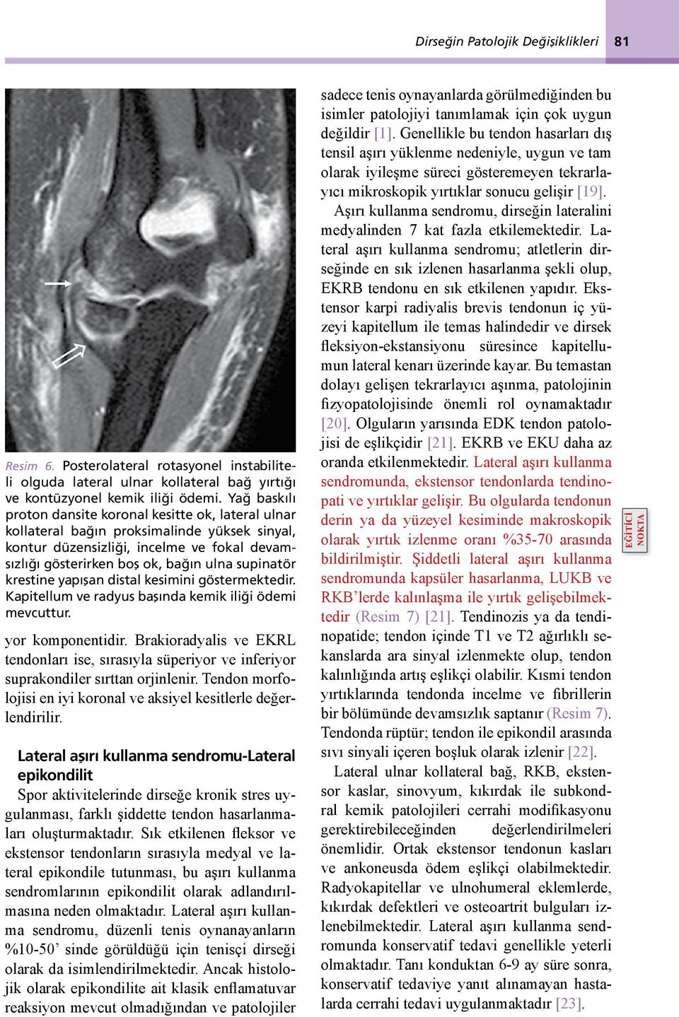 krestine yapışan distal kesimini göstermektedir. Kapitellum ve radyus başında kemik iliği ödemi mevcuttur. yor komponentidir.