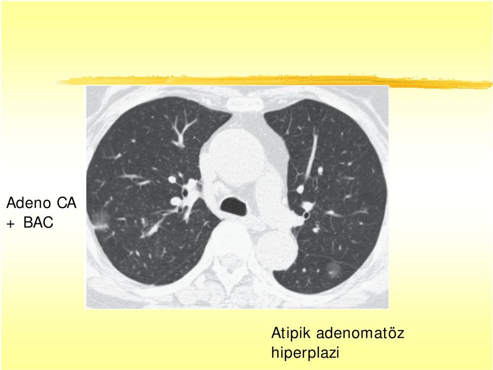 adenomatöz