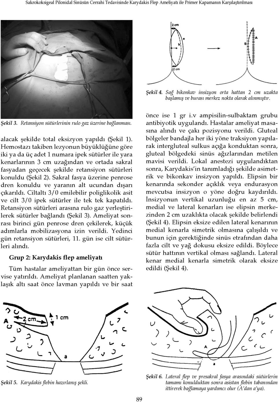 Hemostazı takiben lezyonun büyüklüğüne göre iki ya da üç adet 1 numara ipek sütürler ile yara kenarlarının 3 cm uzağından ve ortada sakral fasyadan geçecek şekilde retansiyon sütürleri konuldu (Şekil