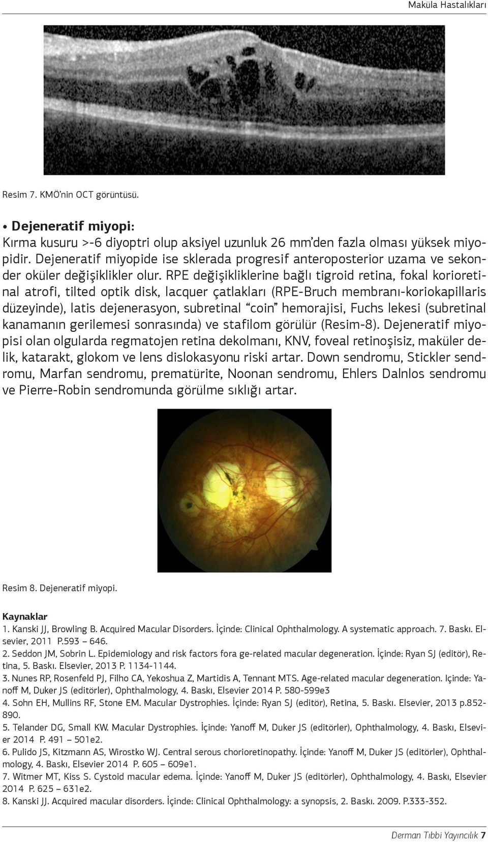 RPE değişikliklerine bağlı tigroid retina, fokal korioretinal atrofi, tilted optik disk, lacquer çatlakları (RPE-Bruch membranı-koriokapillaris düzeyinde), latis dejenerasyon, subretinal coin