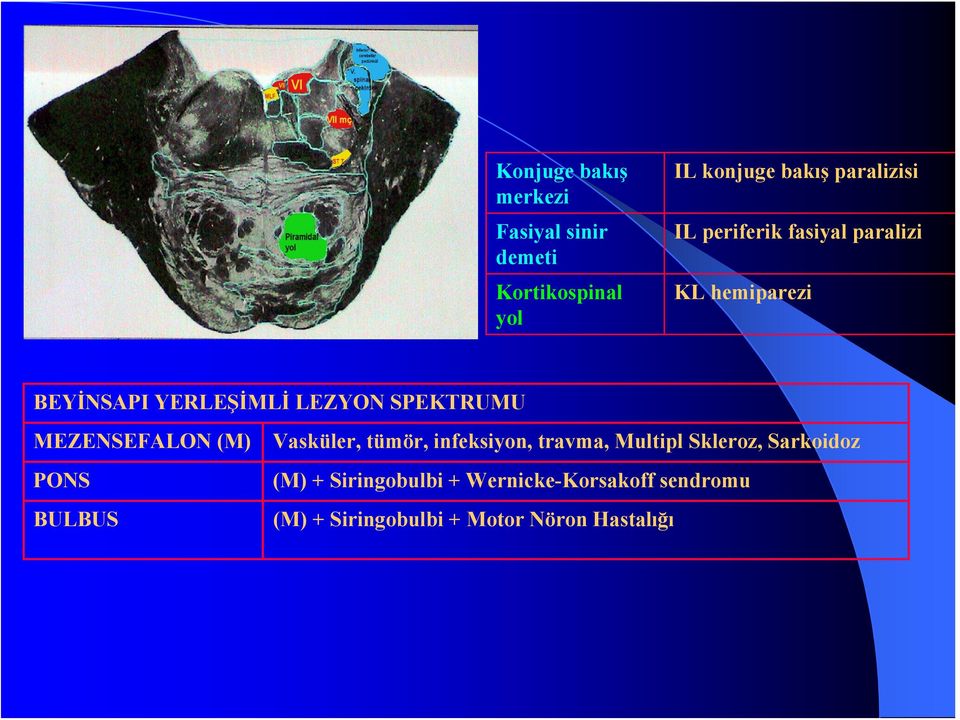 MEZENSEFALON (M) PONS BULBUS Vasküler, tümör, infeksiyon, travma, Multipl Skleroz,