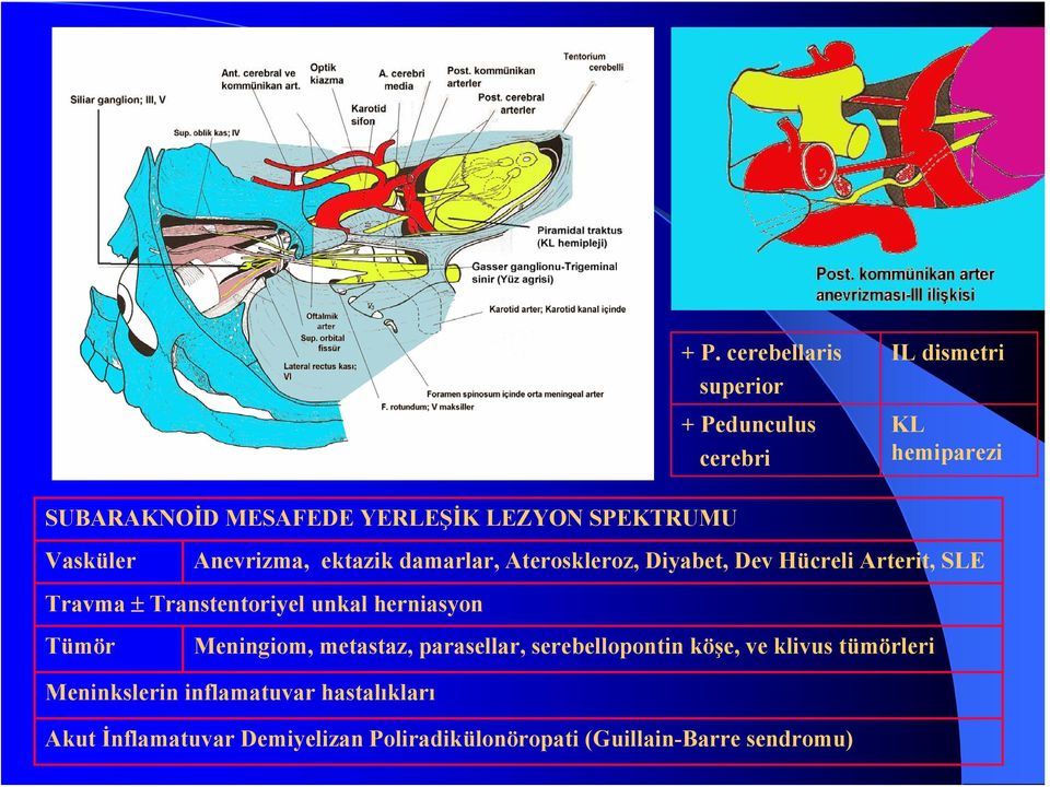 Transtentoriyel unkal herniasyon Tümör Meningiom, metastaz, parasellar, serebellopontin köşe, ve klivus