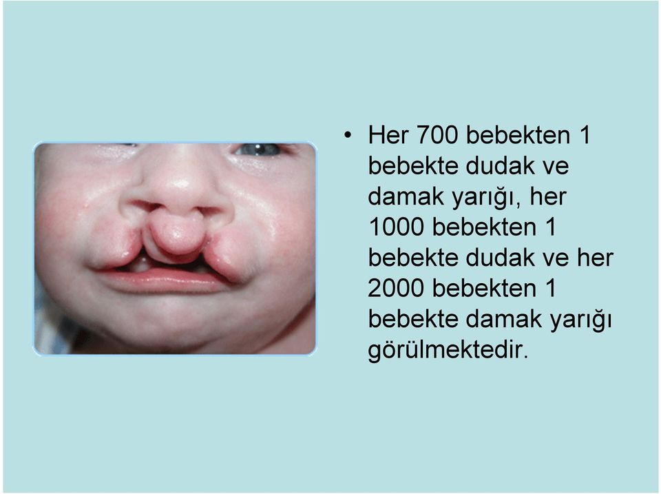 bebekte dudak ve her 2000 bebekten