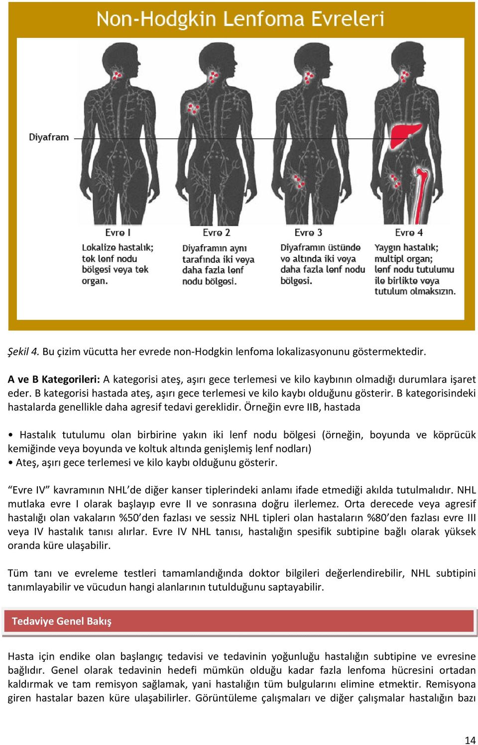 Örneğin evre IIB, hastada Hastalık tutulumu olan birbirine yakın iki lenf nodu bölgesi (örneğin, boyunda ve köprücük kemiğinde veya boyunda ve koltuk altında genişlemiş lenf nodları) Ateş, aşırı gece