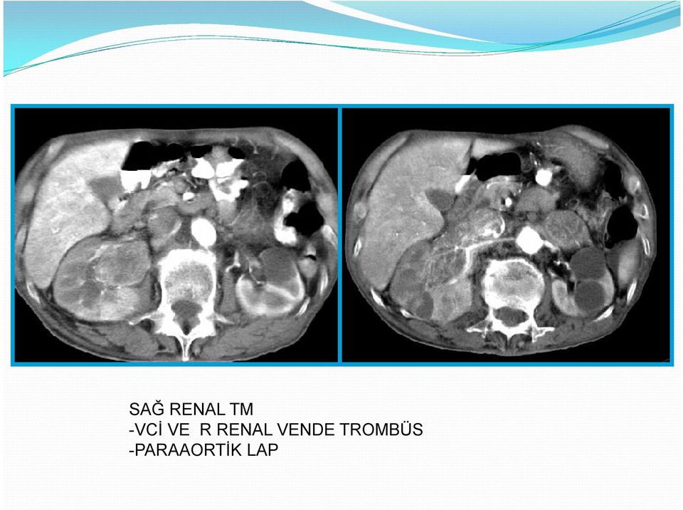 RENAL VENDE