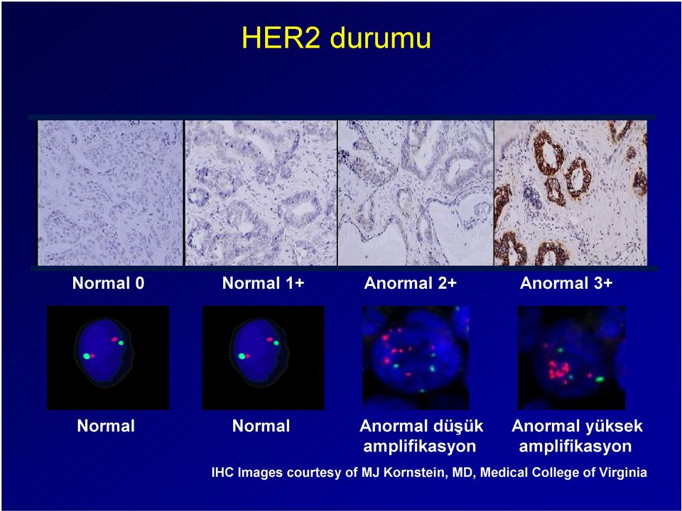 amplifikasyon Anormal yüksek amplifikasyon IHC