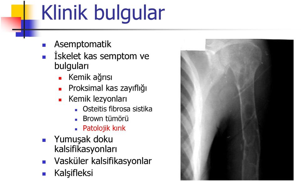 lezyonları Osteitis fibrosa sistika Brown tümörü Patolojik