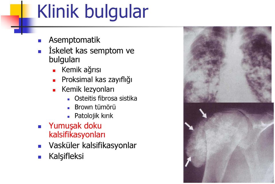 lezyonları Osteitis fibrosa sistika Brown tümörü Patolojik