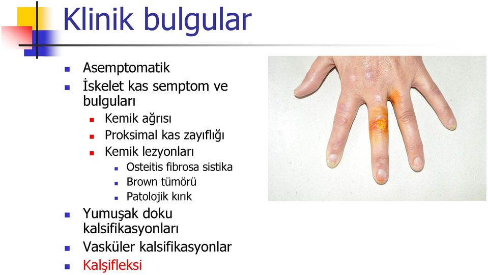 lezyonları Osteitis fibrosa sistika Brown tümörü Patolojik