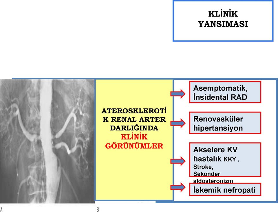 İnsidental RAD Renovasküler hipertansiyon Akselere KV