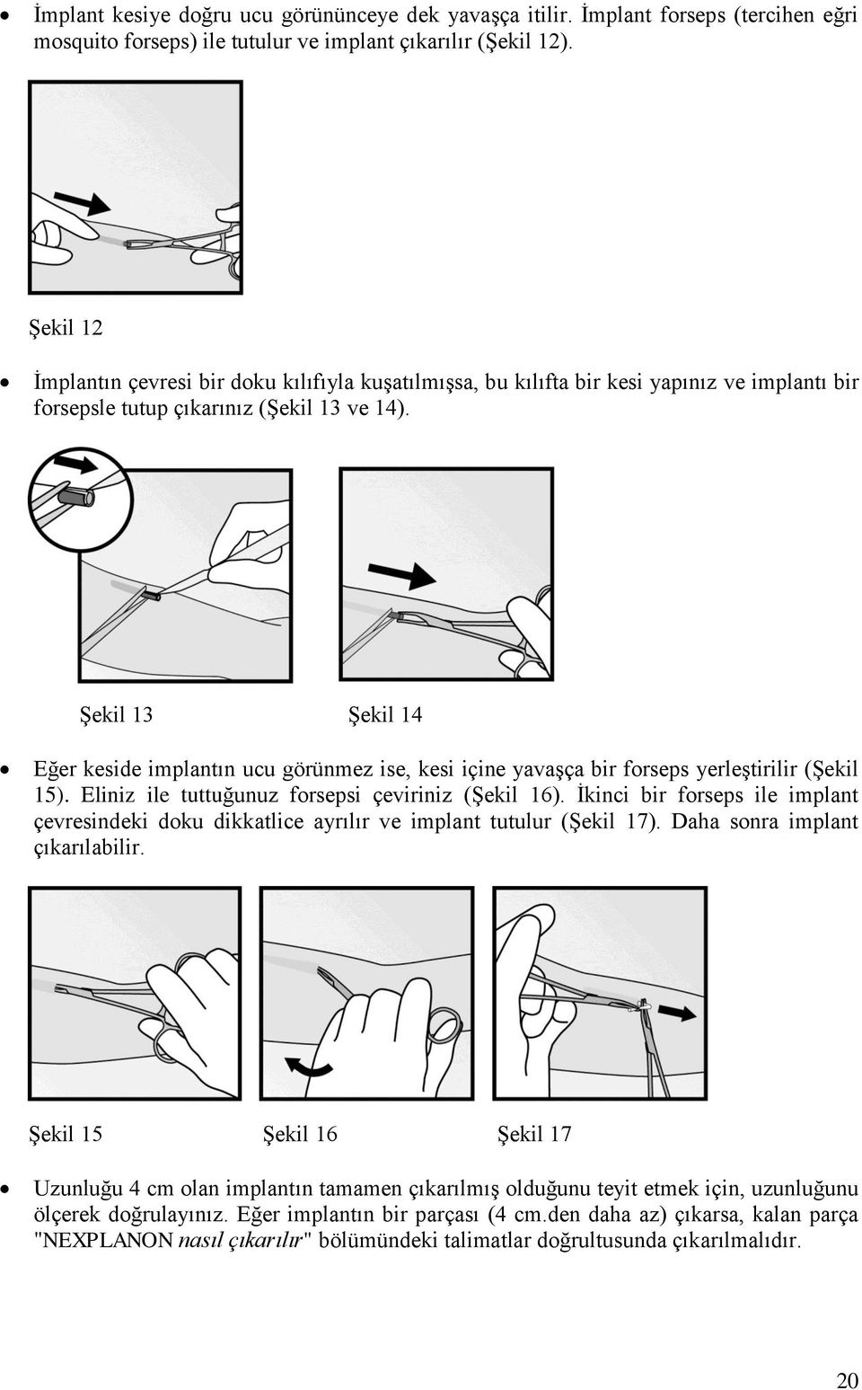 Şekil 13 Şekil 14 Eğer keside implantın ucu görünmez ise, kesi içine yavaşça bir forseps yerleştirilir (Şekil 15). Eliniz ile tuttuğunuz forsepsi çeviriniz (Şekil 16).