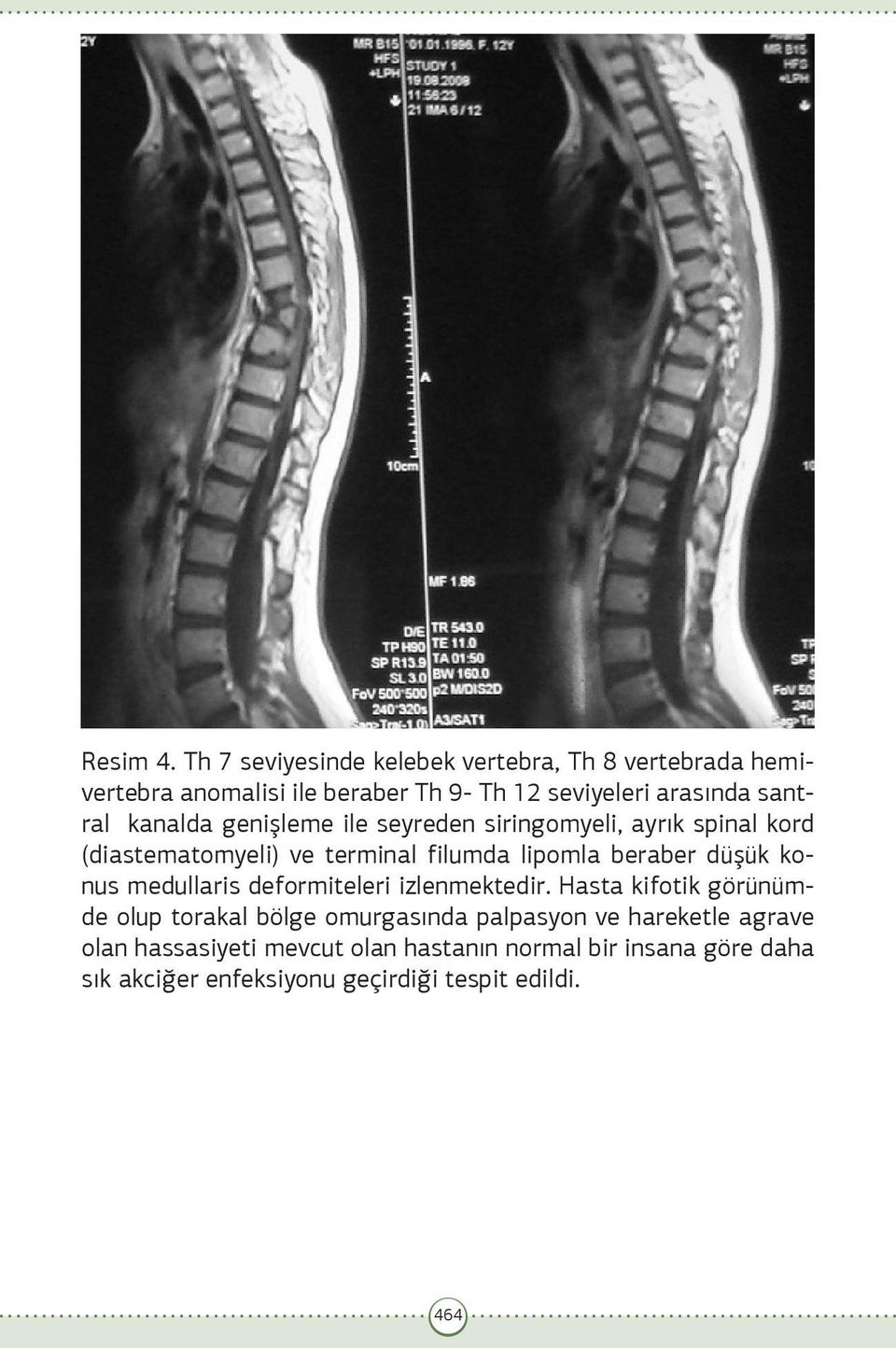kanalda genişleme ile seyreden siringomyeli, ayrık spinal kord (diastematomyeli) ve terminal filumda lipomla beraber düşük