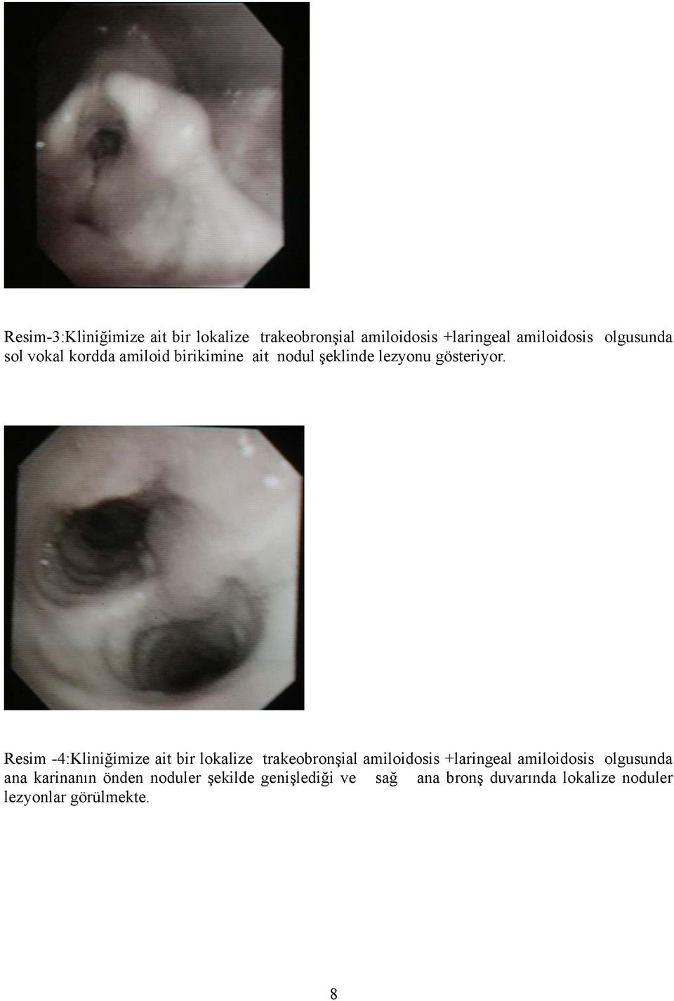 Resim -4:Kliniğimize ait bir lokalize trakeobronşial amiloidosis +laringeal amiloidosis