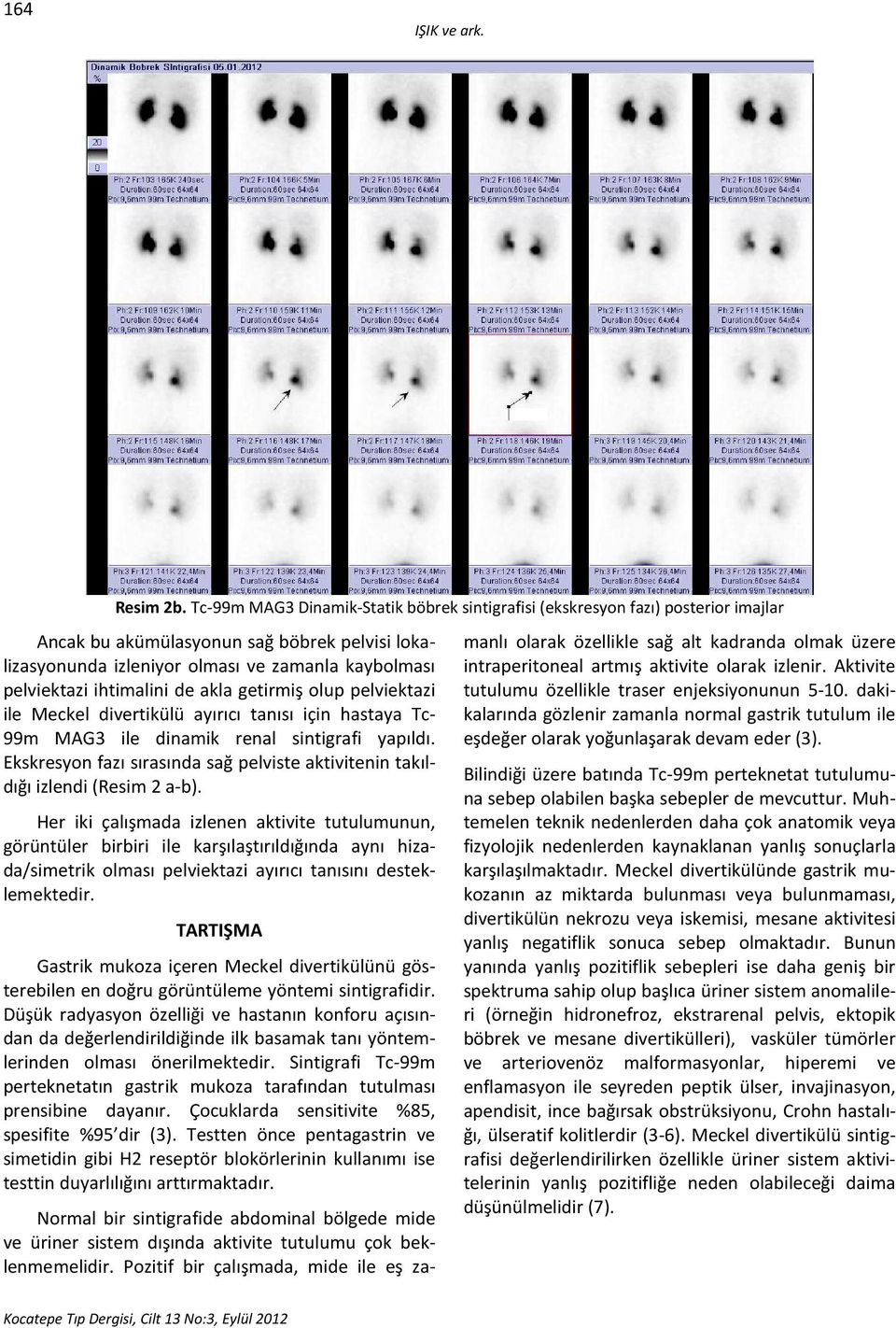 ihtimalini de akla getirmiş olup pelviektazi ile Meckel divertikülü ayırıcı tanısı için hastaya Tc- 99m MAG3 ile dinamik renal sintigrafi yapıldı.