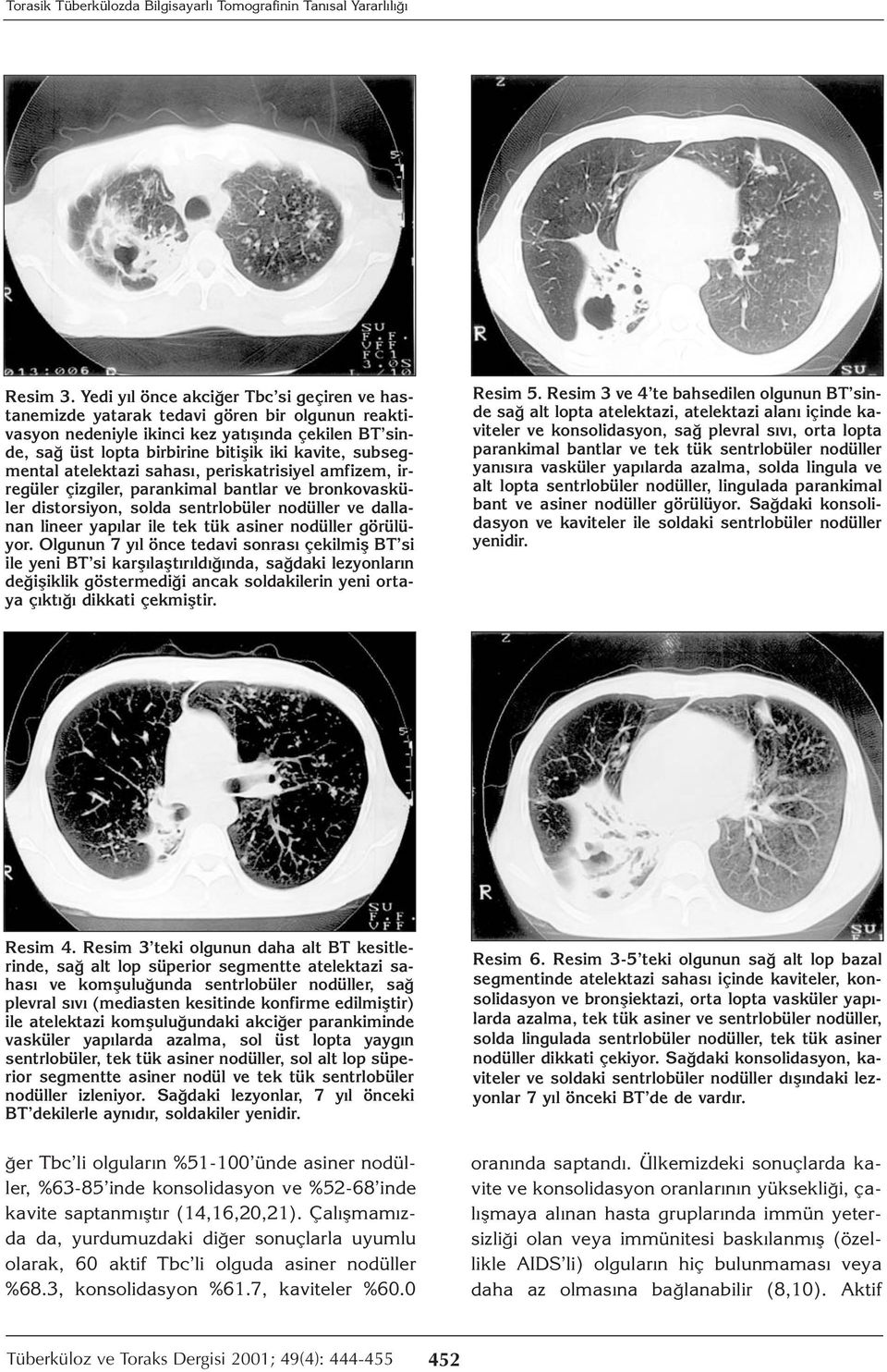 subsegmental atelektazi sahası, periskatrisiyel amfizem, irregüler çizgiler, parankimal bantlar ve bronkovasküler distorsiyon, solda sentrlobüler nodüller ve dallanan lineer yapılar ile tek tük