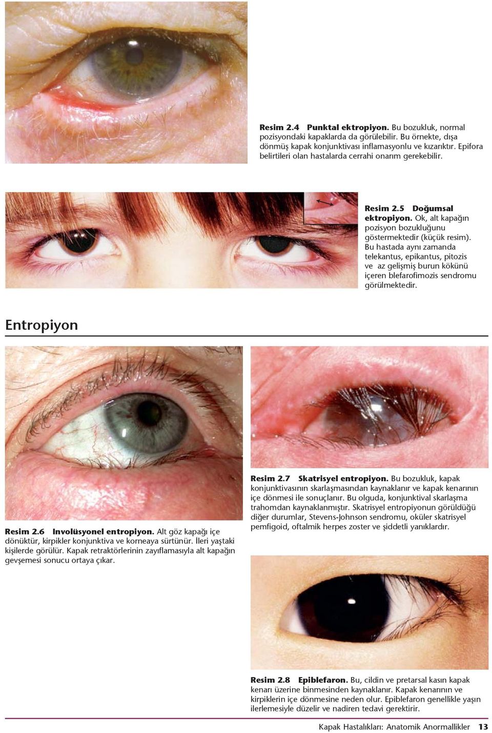 Bu hastada aynı zamanda telekantus, epikantus, pitozis ve az gelişmiş burun kökünü içeren blefarofimozis sendromu görülmektedir. Entropiyon Resim 2.6 Involüsyonel entropiyon.