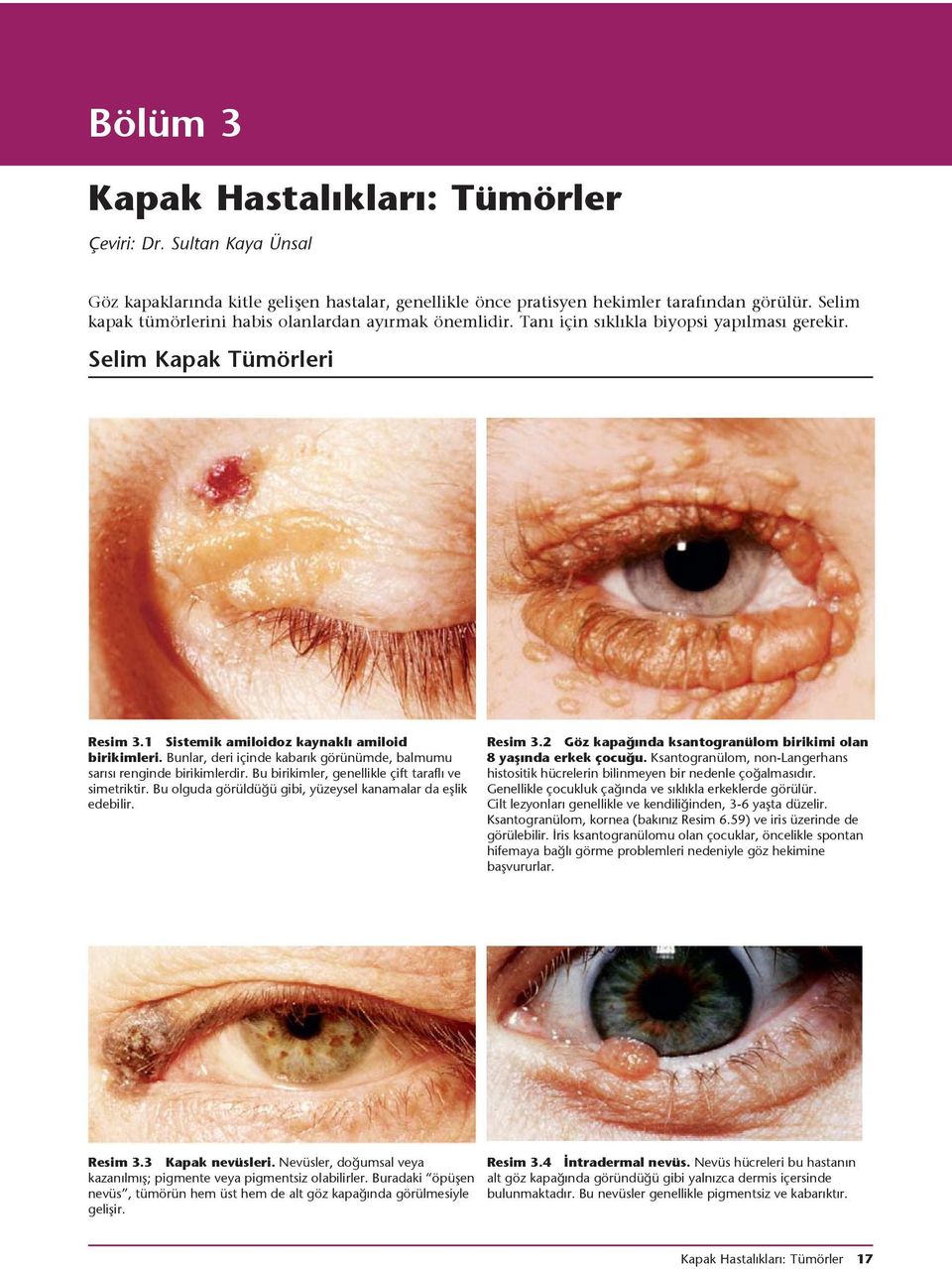 Bunlar, deri içinde kabarık görünümde, balmumu sarısı renginde birikimlerdir. Bu birikimler, genellikle çift taraflı ve simetriktir. Bu olguda görüldüğü gibi, yüzeysel kanamalar da eşlik edebilir.