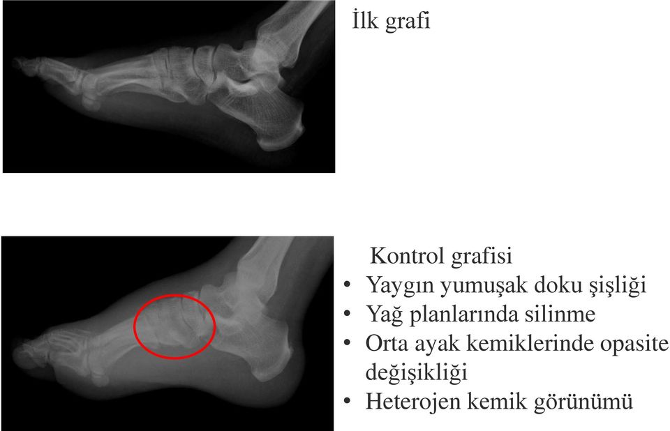 silinme Orta ayak kemiklerinde