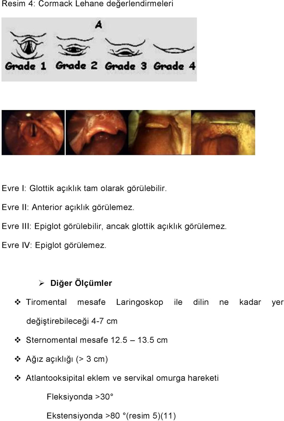 Evre IV: Epiglot görülemez.