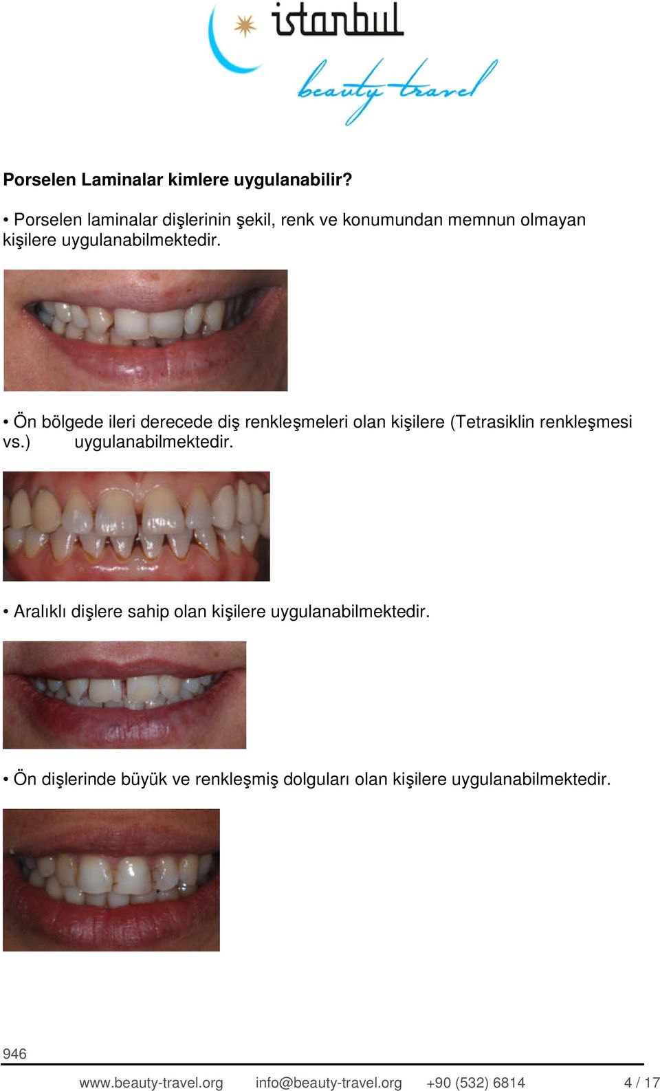 Ön bölgede ileri derecede diş renkleşmeleri olan kişilere (Tetrasiklin renkleşmesi vs.) uygulanabilmektedir.