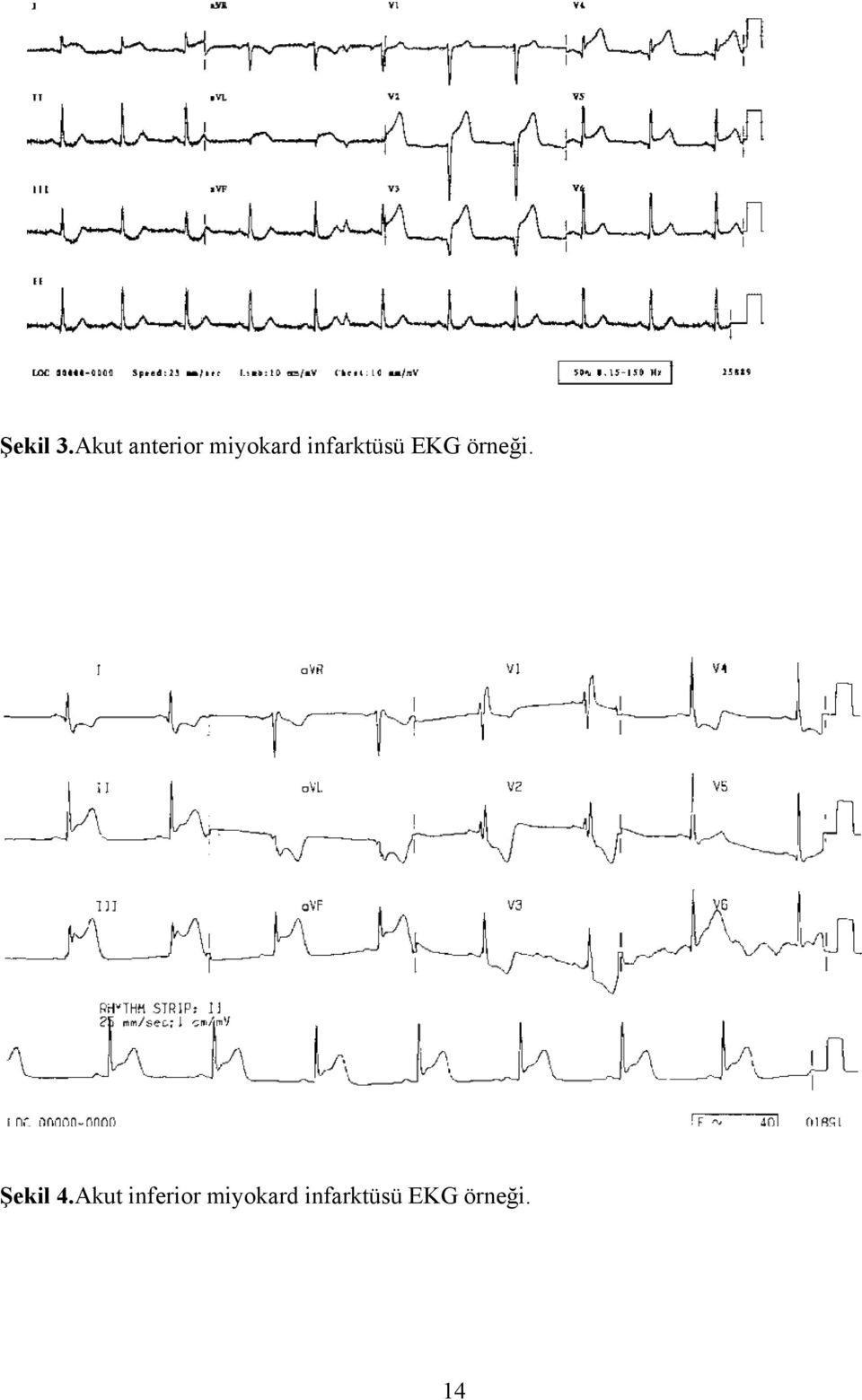 infarktüsü EKG örneği.