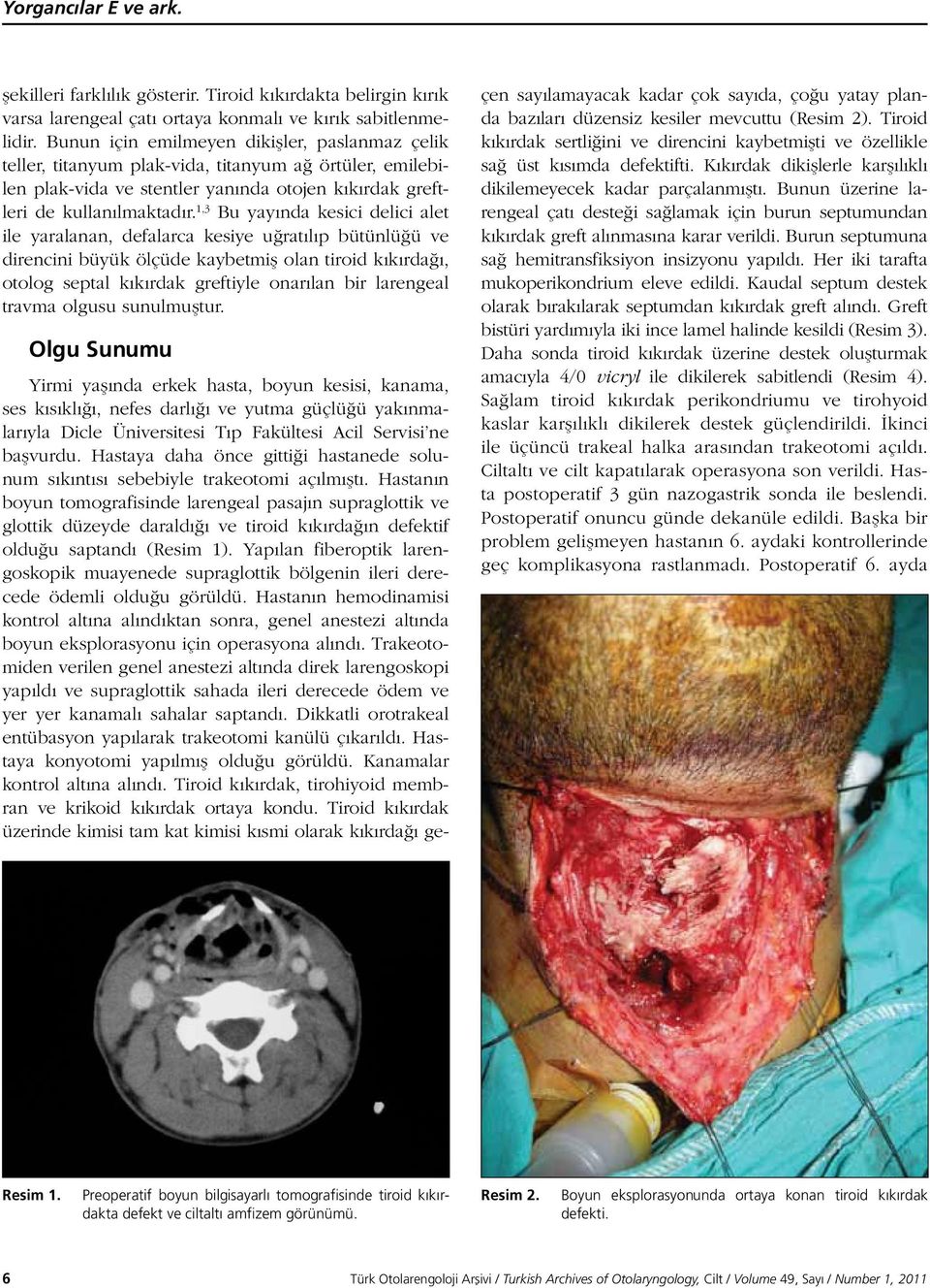 1,3 Bu yayında kesici delici alet ile yaralanan, defalarca kesiye uğratılıp bütünlüğü ve direncini büyük ölçüde kaybetmiş olan tiroid kıkırdağı, otolog septal kıkırdak greftiyle onarılan bir