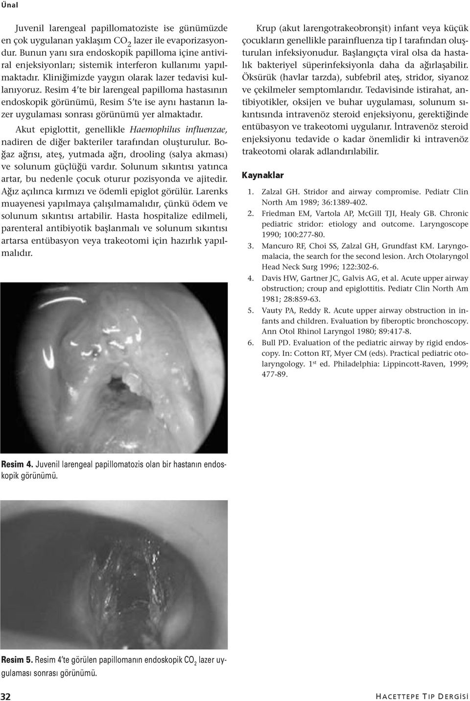 Resim 4 te bir larengeal papilloma hastasının endoskopik görünümü, Resim 5 te ise aynı hastanın lazer uygulaması sonrası görünümü yer almaktadır.