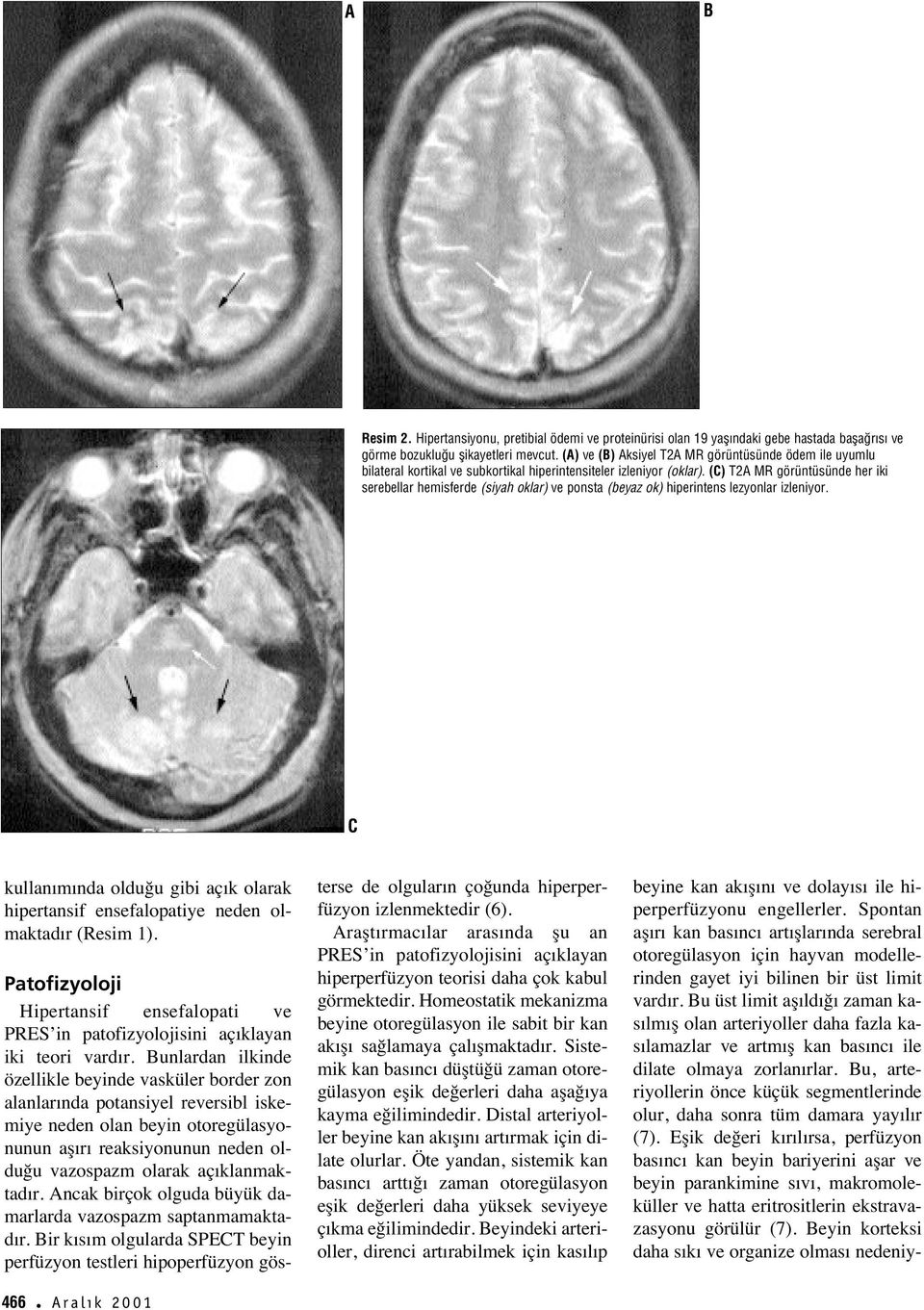 () T2A MR görüntüsünde her iki serebellar hemisferde (siyah oklar) ve ponsta (beyaz ok) hiperintens lezyonlar izleniyor.