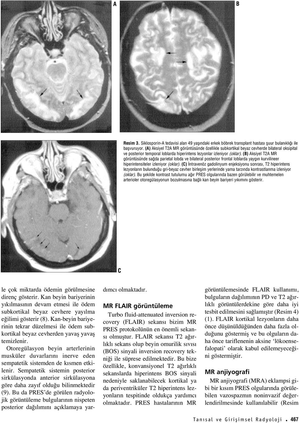 () Aksiyel T2A MR görüntüsünde sa da parietal lobda ve bilateral posterior frontal loblarda yayg n kurvilineer hiperintensiteler izleniyor (oklar).