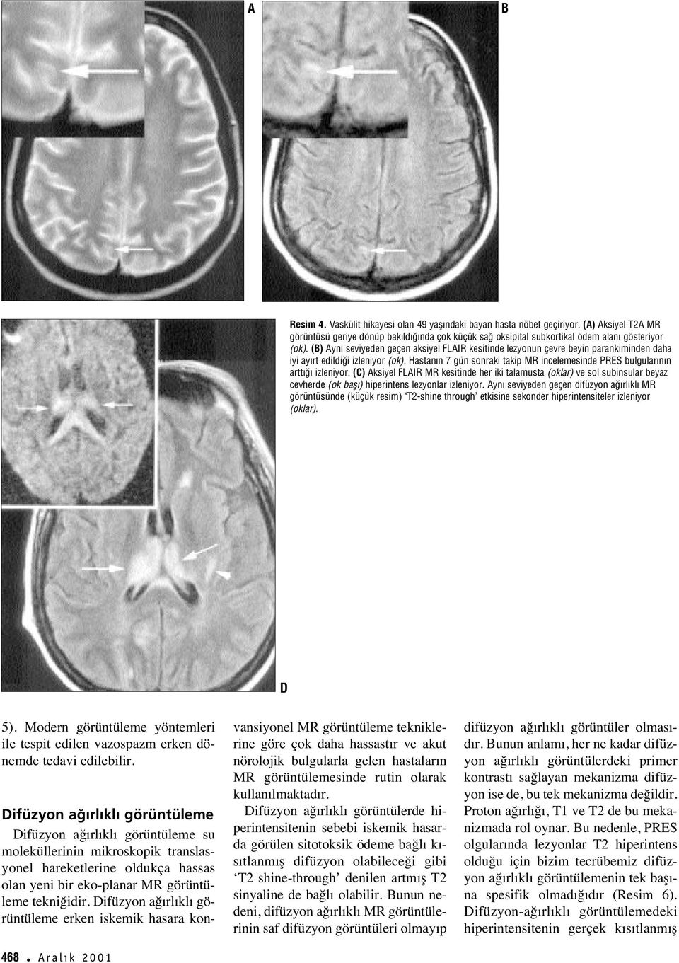 Hastan n 7 gün sonraki takip MR incelemesinde PRES bulgular n n artt izleniyor.