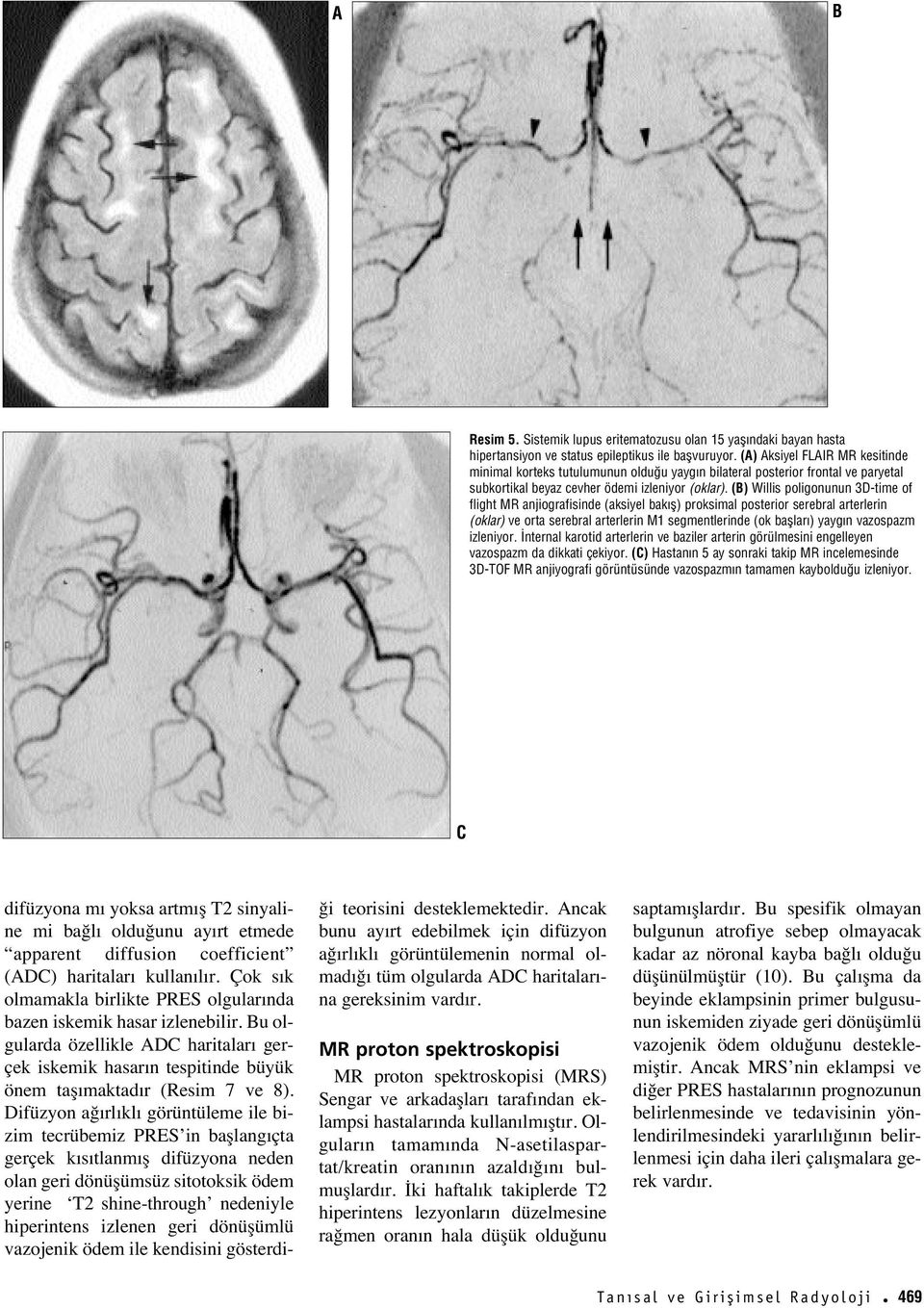 () Willis poligonunun 3D-time of flight MR anjiografisinde (aksiyel bak fl) proksimal posterior serebral arterlerin (oklar) ve orta serebral arterlerin M1 segmentlerinde (ok bafllar ) yayg n