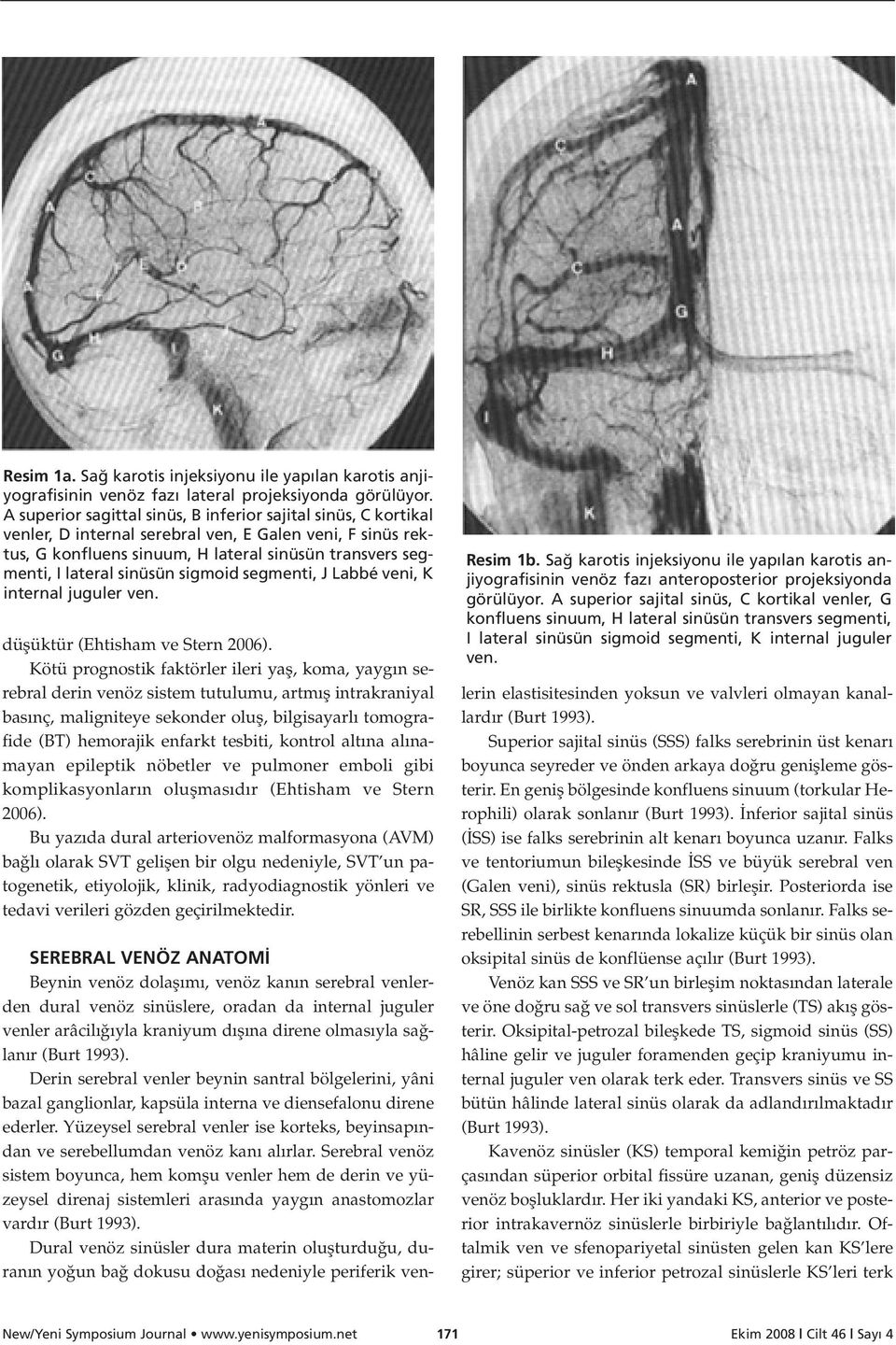 sinüsün sigmoid segmenti, J Labbé veni, K internal juguler ven. düflüktür (Ehtisham ve Stern 2006).