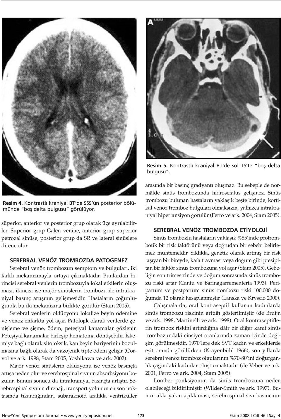 SEREBRAL VENÖZ TROMBOZDA PATOGENEZ Serebral venöz trombozun semptom ve bulgular, iki farkl mekanizmayla ortaya ç kmaktad r.