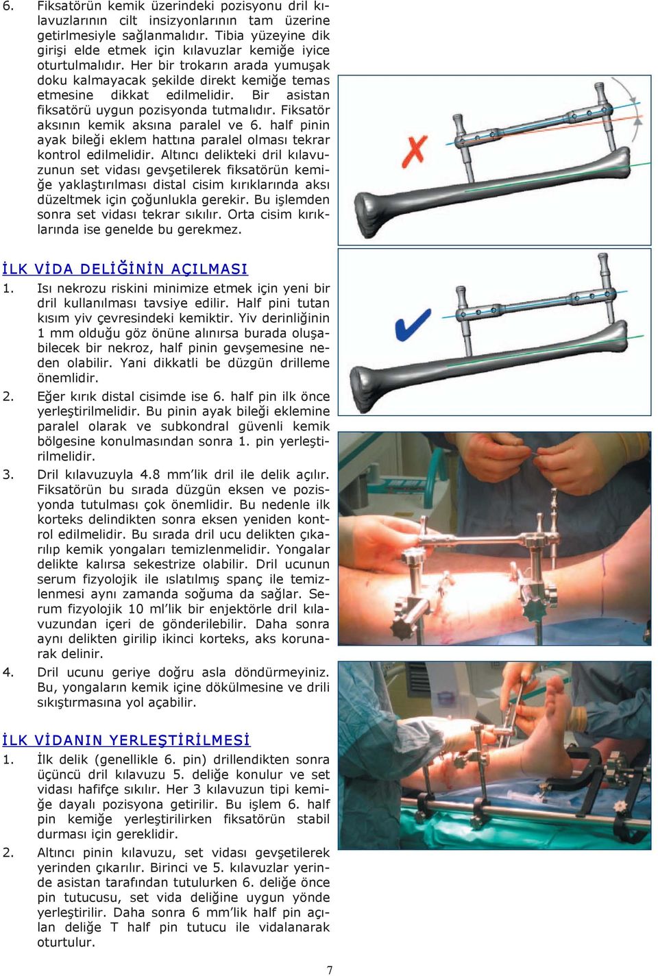 Bir asistan fiksatörü uygun pozisyonda tutmalıdır. Fiksatör aksının kemik aksına paralel ve 6. half pinin ayak bileği eklem hattına paralel olması tekrar kontrol edilmelidir.