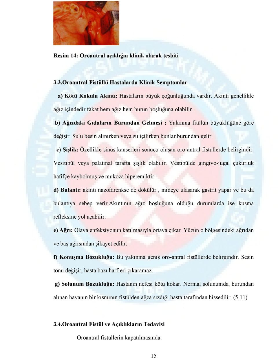 Sulu besin alınırken veya su içilirken bunlar burundan gelir. c) Şişlik: Özellikle sinüs kanserleri sonucu oluşan oro-antral fistüllerde belirgindir. Vesitibül veya palatinal tarafta şişlik olabilir.