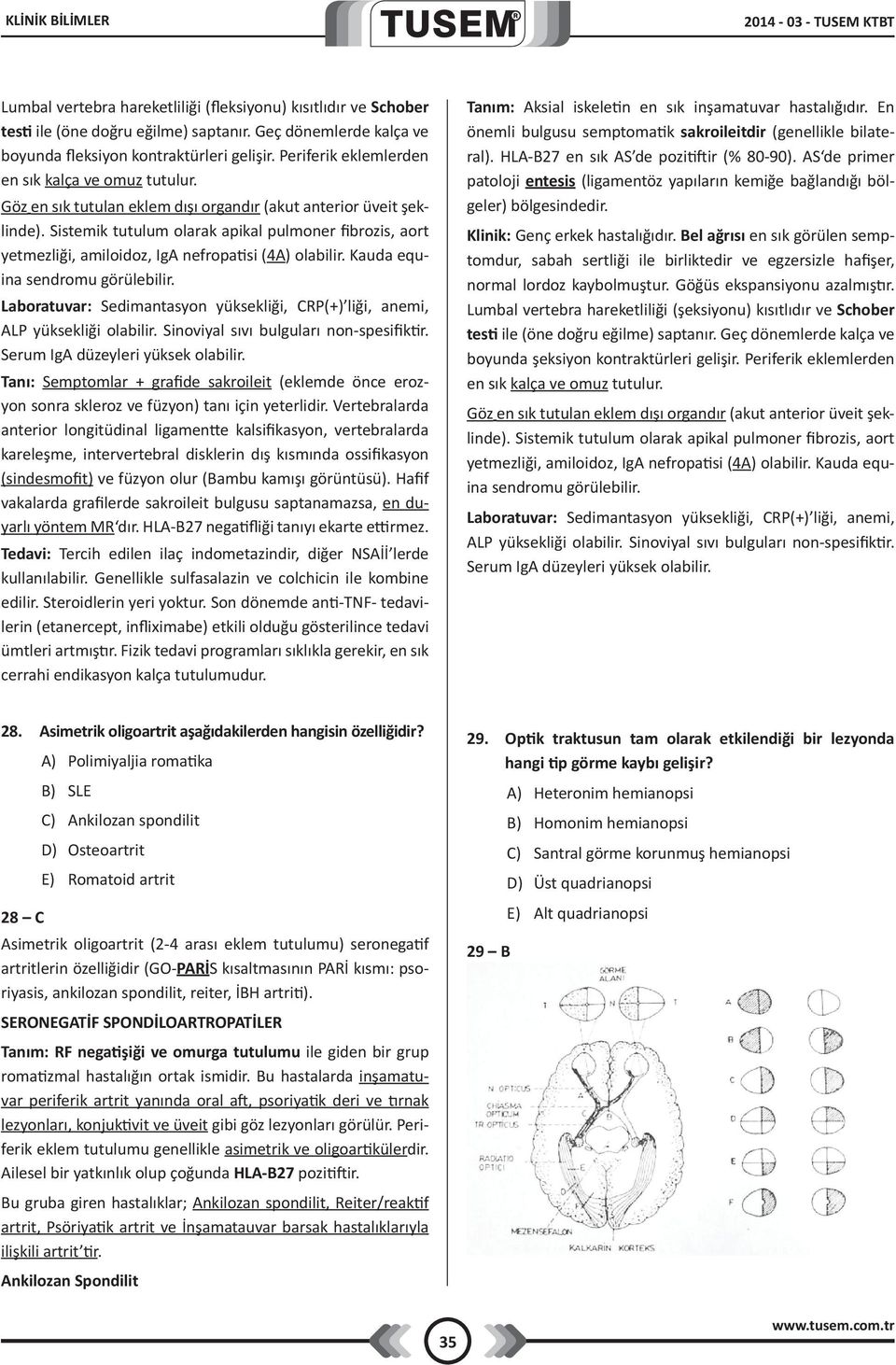 Sistemik tutulum olarak apikal pulmoner fibrozis, aort yetmezliği, amiloidoz, IgA nefropatisi (4A) olabilir. Kauda equina sendromu görülebilir.