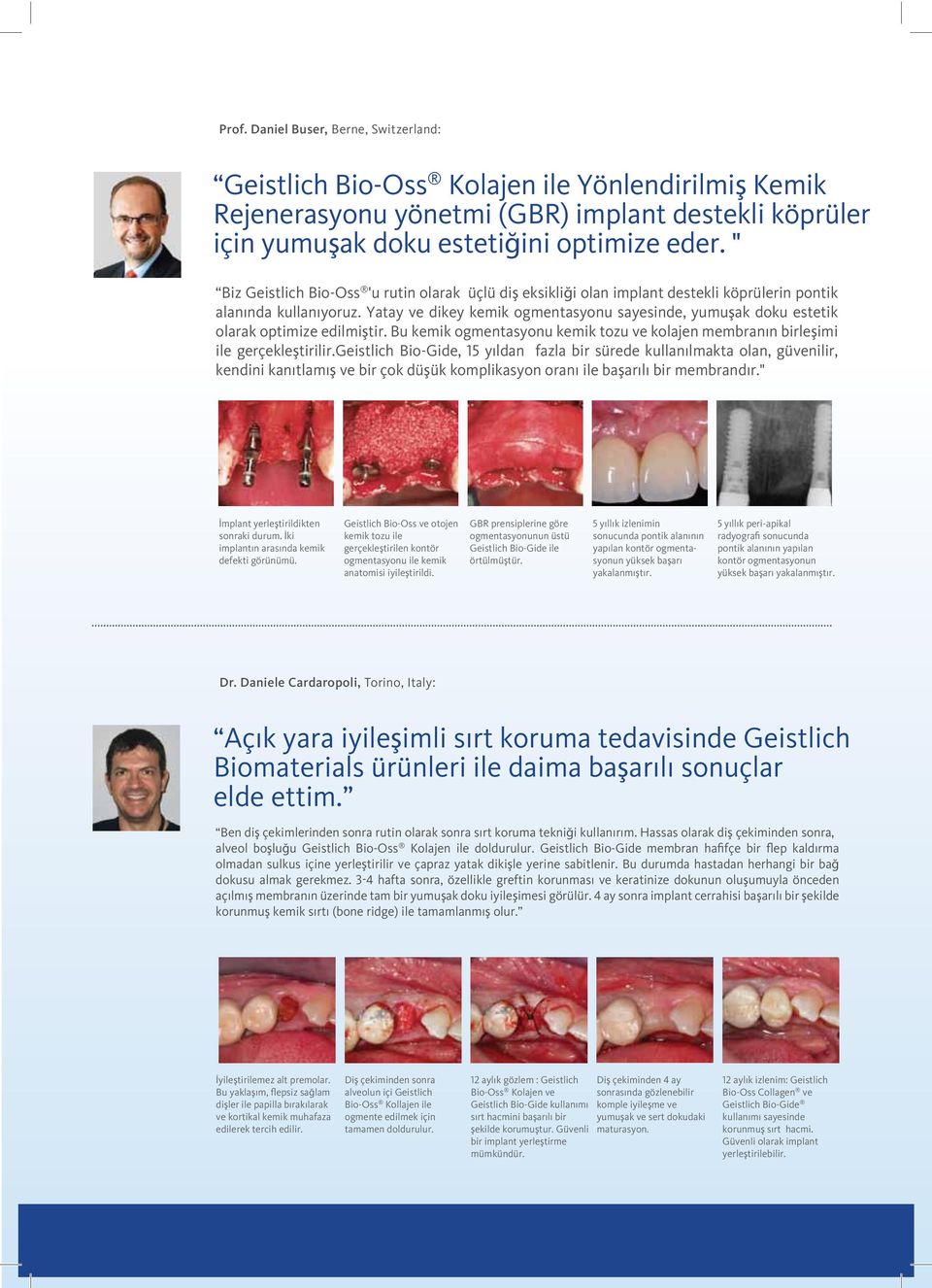 Yatay ve dikey kemik ogmentasyonu sayesinde, yumuşak doku estetik olarak optimize edilmiştir. Bu kemik ogmentasyonu kemik tozu ve kolajen membranın birleşimi ile gerçekleştirilir.