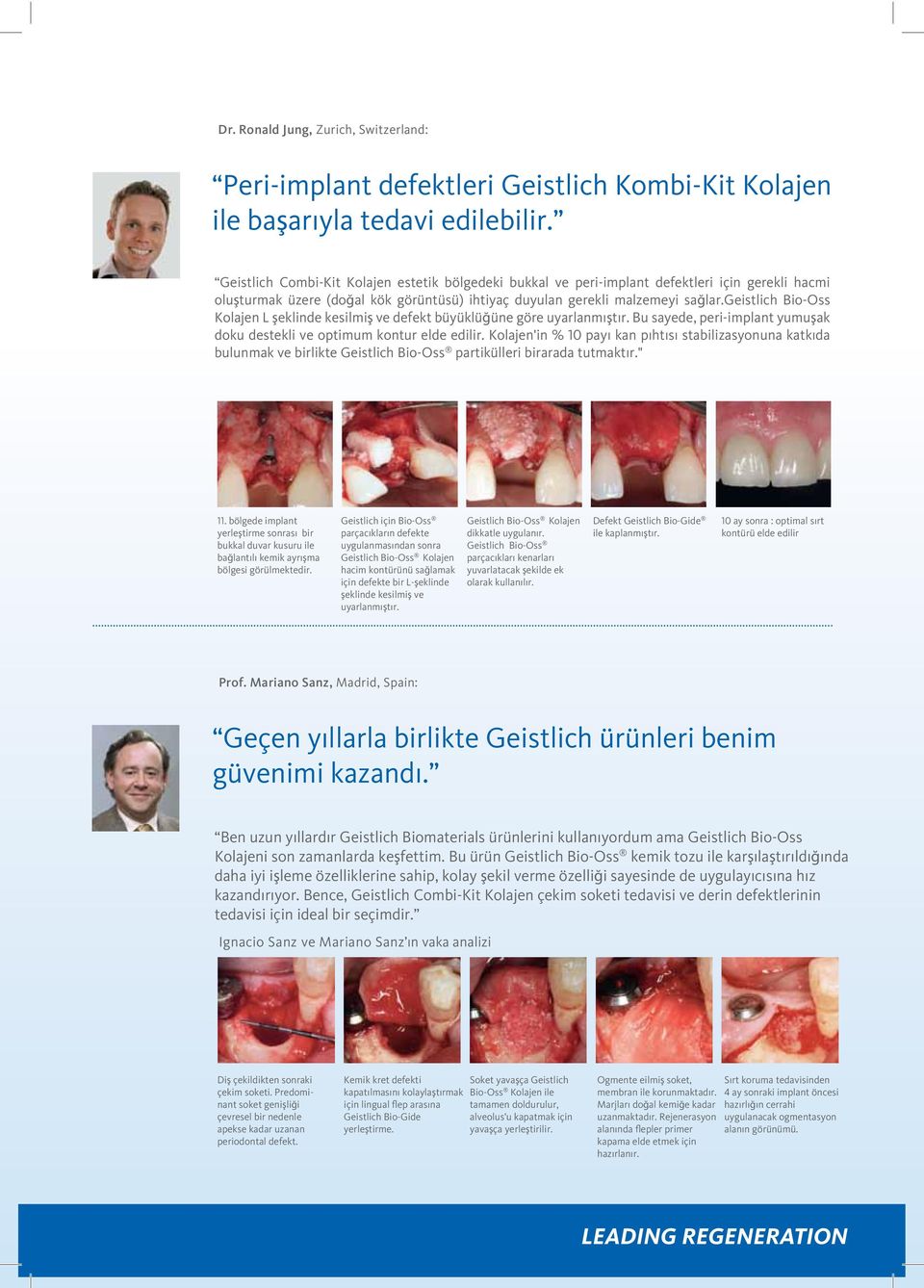 geistlich Bio-Oss Kolajen L şeklinde kesilmiş ve defekt büyüklüğüne göre uyarlanmıştır. Bu sayede, peri-implant yumuşak doku destekli ve optimum kontur elde edilir.