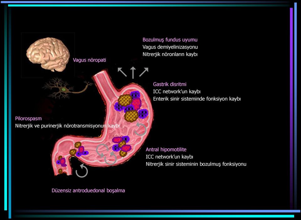 Pilorospasm Nitrerjik ve purinerjik nörotransmisyonun kaybı Antral hipomotilite ICC