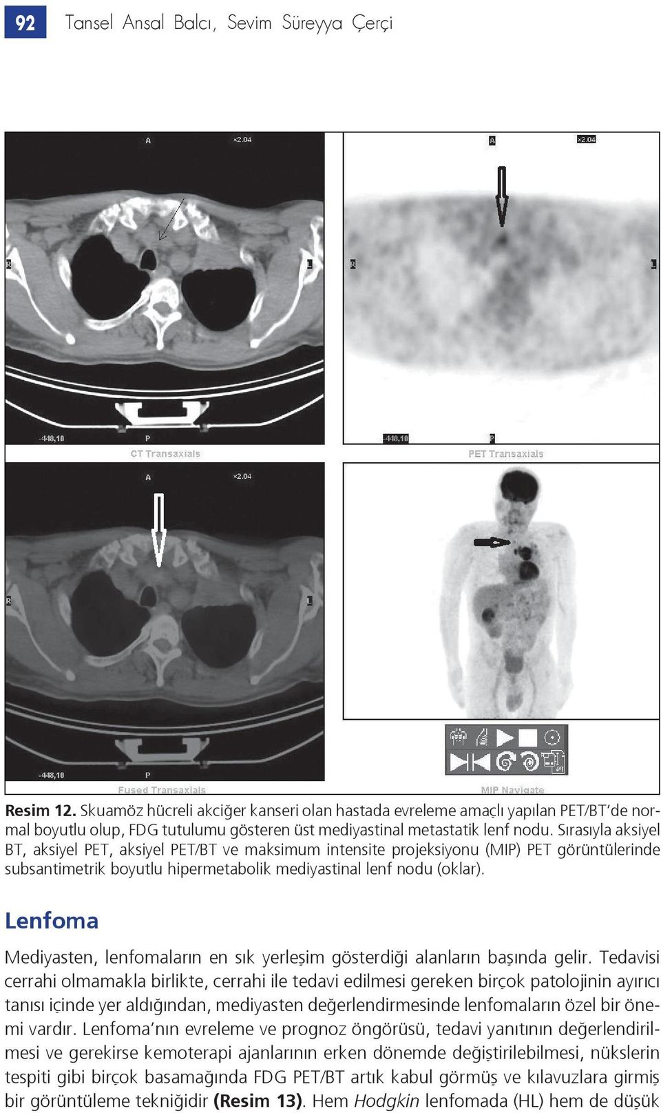 Sırasıyla aksiyel BT, aksiyel PET, aksiyel PET/BT ve maksimum intensite projeksiyonu (MIP) PET görüntülerinde subsantimetrik boyutlu hipermetabolik mediyastinal lenf nodu (oklar).