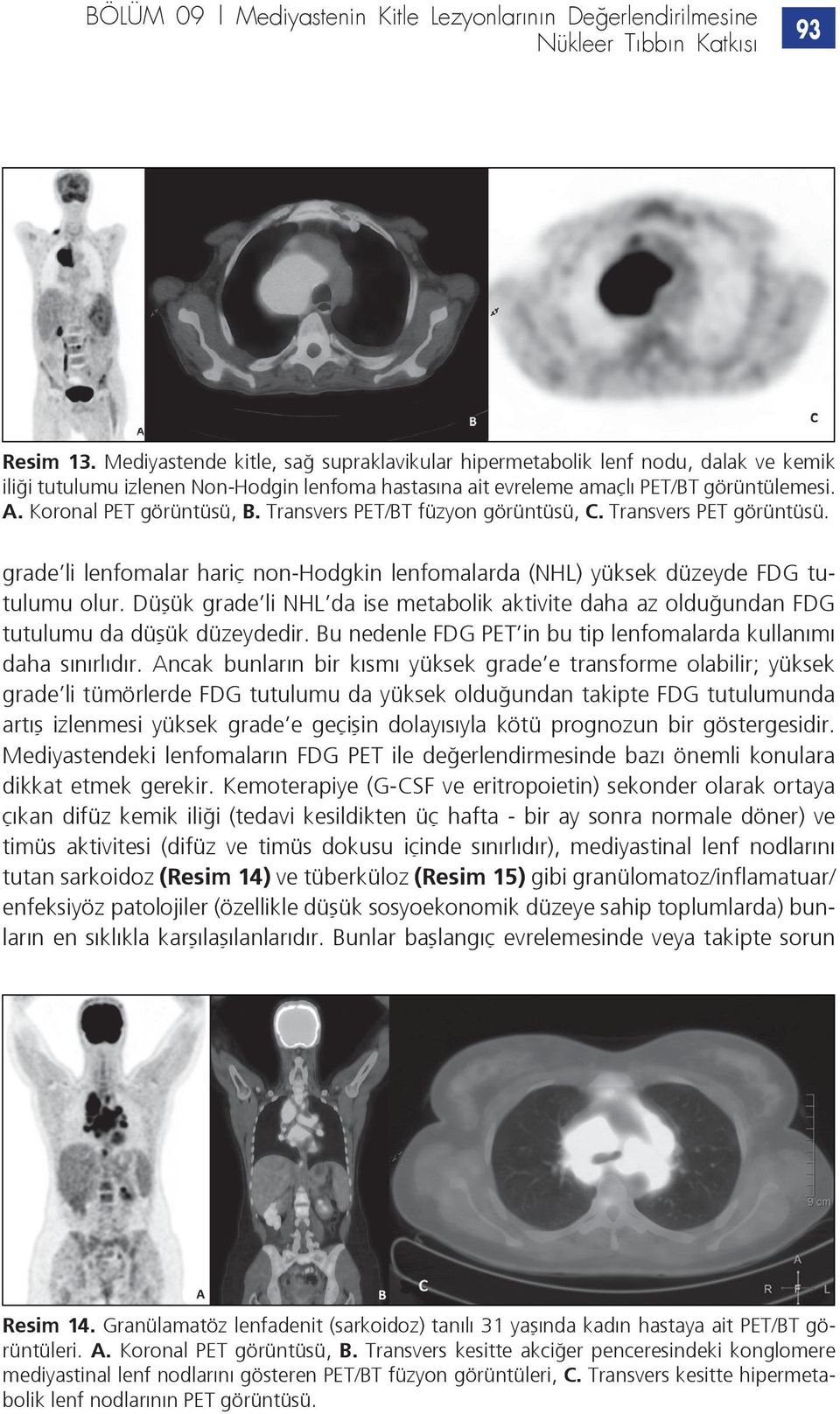 Koronal PET görüntüsü, B. Transvers PET/BT füzyon görüntüsü, C. Transvers PET görüntüsü. grade li lenfomalar hariç non-hodgkin lenfomalarda (NHL) yüksek düzeyde FDG tutulumu olur.